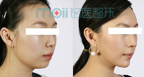 丰下巴,玻尿酸,对比图,长春好的整形医院