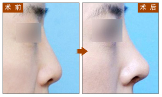 长春隆鼻,对比图,长春好的整形医院