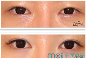 长春双眼皮,开眼角,对比图,长春好的整形医院