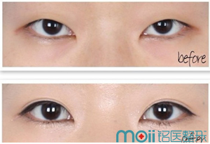 长春双眼皮,开眼角,对比图,长春好的整形医院