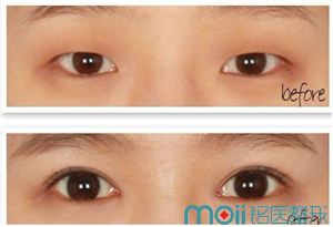 长春双眼皮,开眼角,对比图,长春好的整形医院