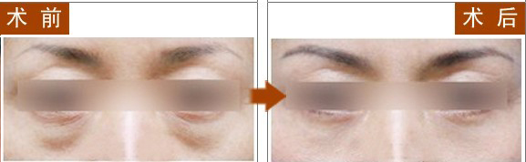 长春祛眼袋,对比图,长春好的整形医院