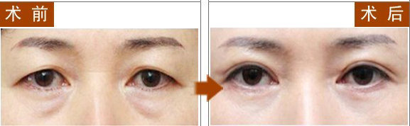 长春祛眼袋,对比图,长春好的整形医院