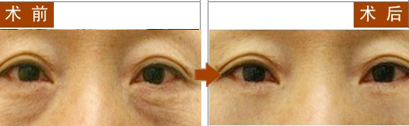 长春祛眼袋,对比图,长春好的整形医院