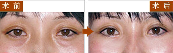 长春祛眼袋,对比图,长春好的整形医院