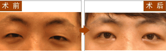 长春祛眼袋,对比图,长春好的整形医院