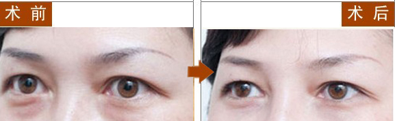 长春祛眼袋,对比图,长春好的整形医院