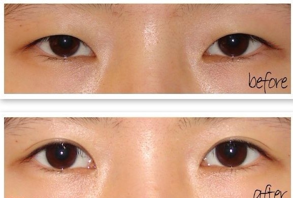 长春双眼皮,开眼角,对比图,长春好的整形医院