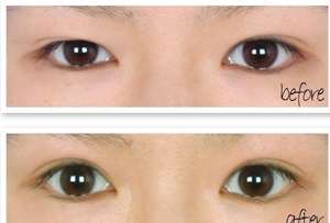 长春双眼皮,开眼角,对比图,长春好的整形医院