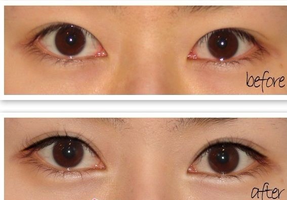 长春双眼皮,开眼角,对比图,长春好的整形医院