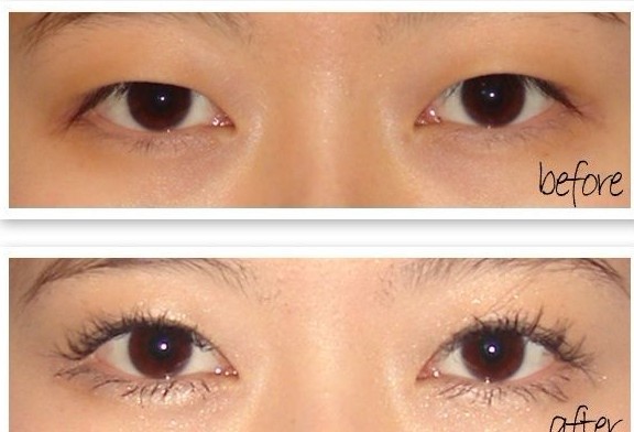 长春双眼皮,开眼角,对比图,长春好的整形医院