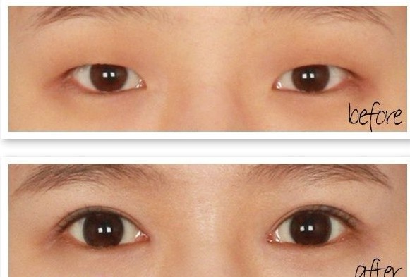 长春双眼皮,开眼角,对比图,长春好的整形医院