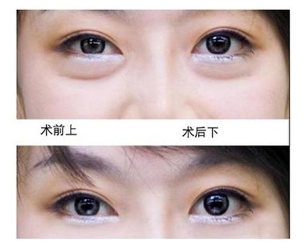 长春祛眼袋,对比图,长春好的整形医院