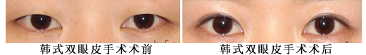 长春双眼皮,开眼角,对比图,长春好的整形医院