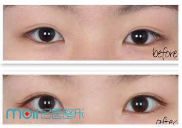 长春双眼皮,开眼角,对比图,长春好的整形医院
