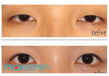 长春双眼皮,开眼角,对比图,长春好的整形医院