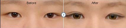 长春双眼皮,开眼角,对比图,长春好的整形医院