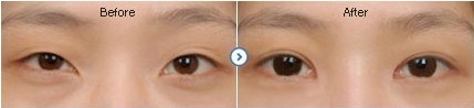 长春双眼皮,开眼角,对比图,长春好的整形医院