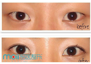 长春双眼皮,开眼角,对比图,长春好的整形医院