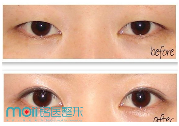 长春双眼皮,开眼角,对比图,长春好的整形医院
