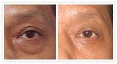 祛眼袋,去眼袋,对比图,长春好的整形医院