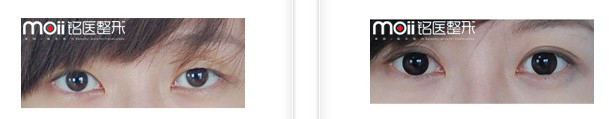 长春双眼皮,开眼角,对比图,长春好的整形医院