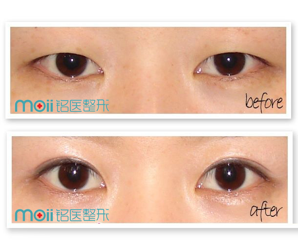 长春双眼皮,开眼角,对比图,长春好的整形医院