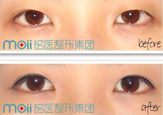 长春双眼皮,开眼角,对比图,长春好的整形医院