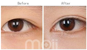 长春双眼皮,开眼角,对比图,长春好的整形医院