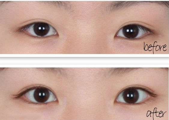 长春,双眼皮,对比图,长春好的整形医院