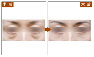 祛眼袋,对比图,长春好的整形医院