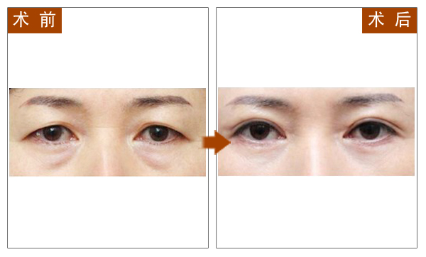 祛眼袋,对比图,长春好的整形医院