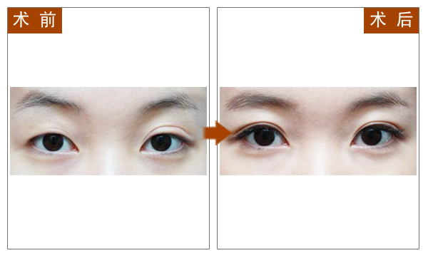 长春双眼皮,对比图,长春好的整形医院