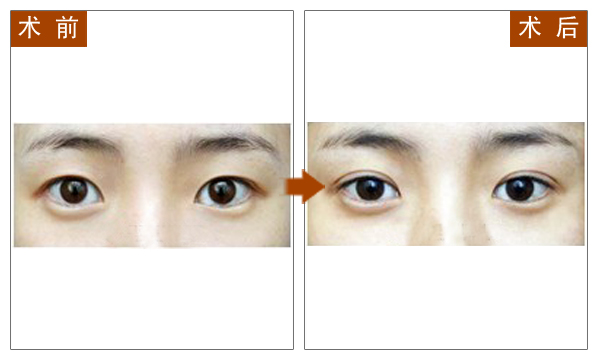 长春双眼皮,对比图,长春好的整形医院
