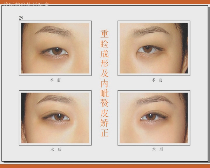 双眼皮,对比图,长春好的整形医院