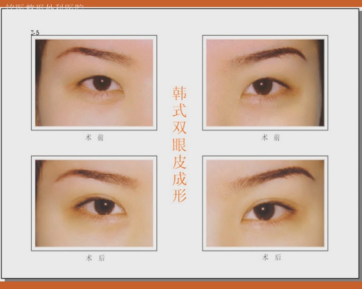 长春眼部整形,对比图,双眼皮,长春好的整形医院