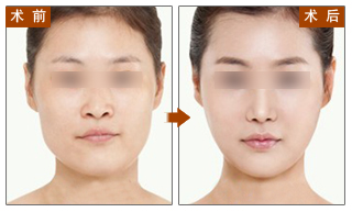 瘦脸,对比图,长春好的整形医院