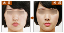 瘦脸,对比图,长春好的整形医院