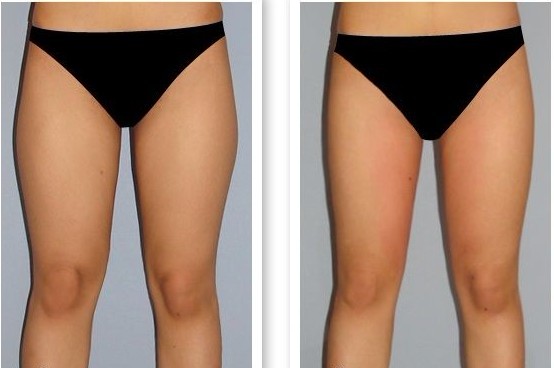 腿部吸脂,减肥,对比图,长春好的整形医院