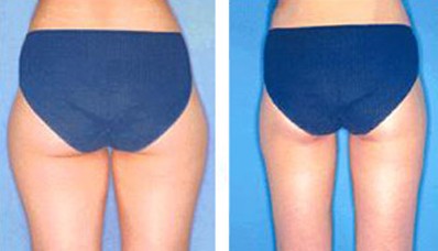 长春大腿吸脂,对比图,长春好的整形医院