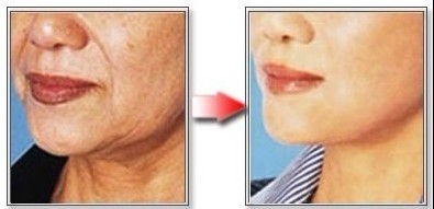 长春,除皱,令纹,对比图,长春好的整形医院