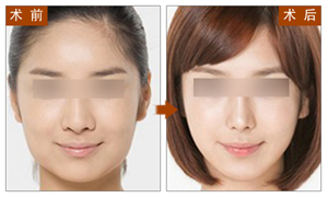 BOTOX,除皱,对比图,长春好的整形医院