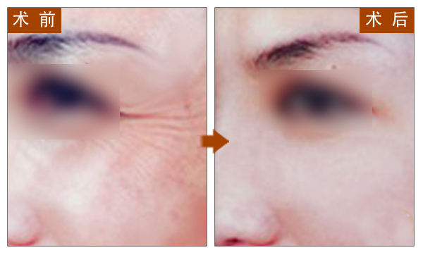 玻尿酸,除皱,对比图,长春好的整形医院