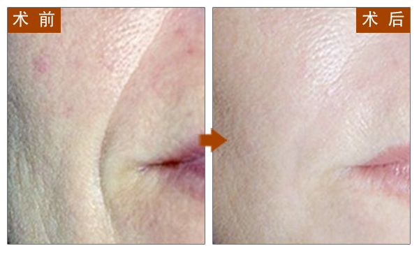 BOTOX,除皱,对比图,长春好的整形医院