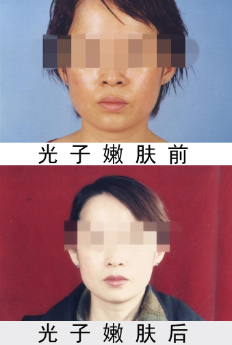 长春光子嫩肤,对比图,长春好的整形医院