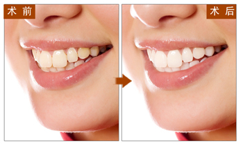 长春口腔,四环素牙美白,瓷贴面,冷光美白