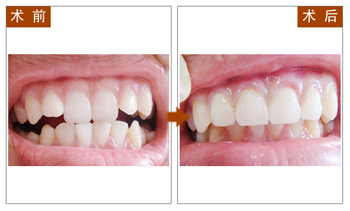 长春口腔,四环素牙美白,瓷贴面,冷光美白