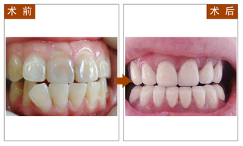 长春口腔,四环素牙美白,瓷贴面,冷光美白